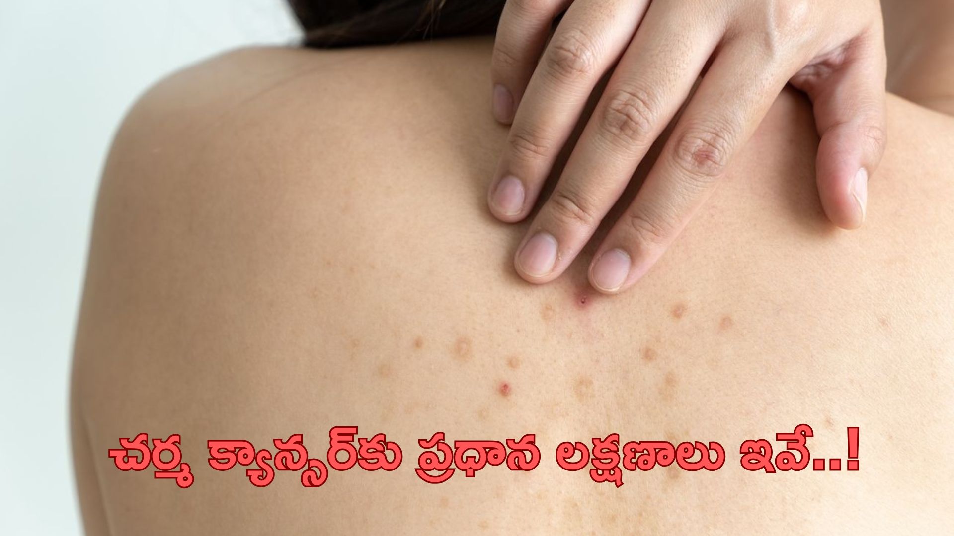 Skin Cancer Symptoms, Treatment: చర్మ క్యాన్సర్‌కు కారణం, లక్షణాలు.. చికిత్స