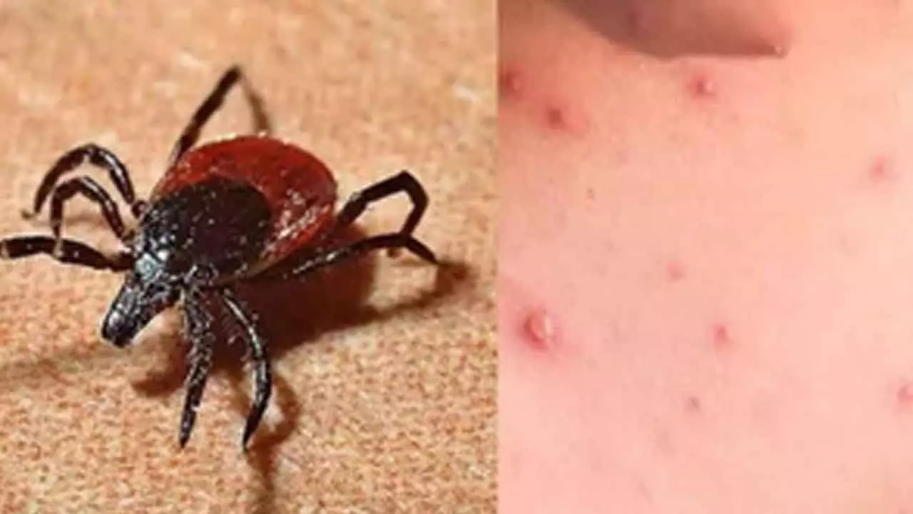 Scrub Typhus: ముంచుకొస్తున్న స్క్రబ్‌ టైఫస్‌.. మరో ఇద్దరు మృతి