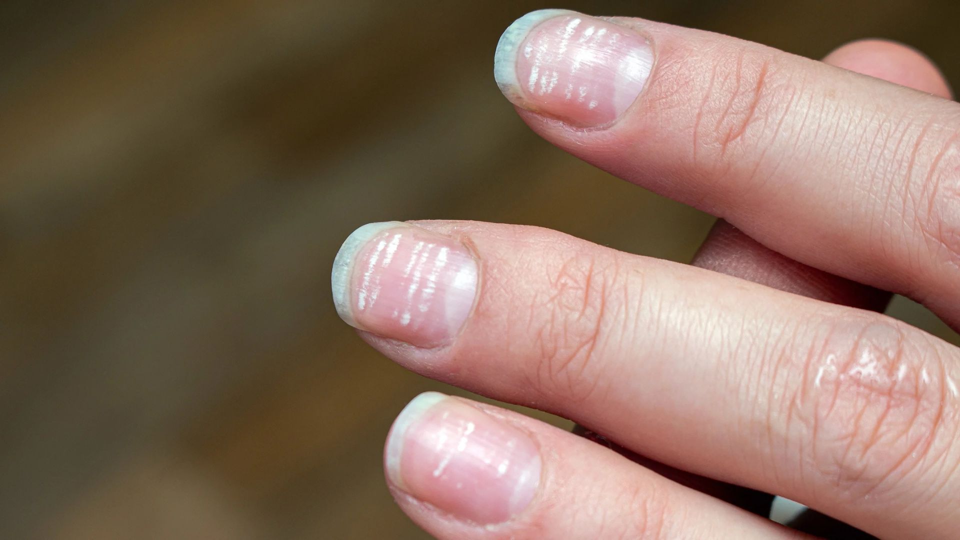 White Spots On Nails: మీ చేతి వేళ్ల గోర్ల‌పై తెల్ల‌ని మ‌చ్చ‌లు ఉన్నాయా? అయితే ఈ విటమిన్ లోపం కావచ్చు..!